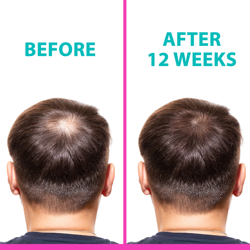 NAPURA T2 Hair Loss Leave-In Vials — 12 x 0.27 fl oz